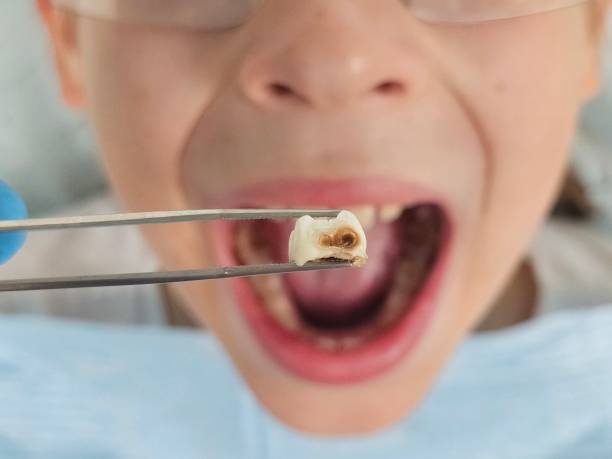 Tooth Infection Emergency Dentist in TN